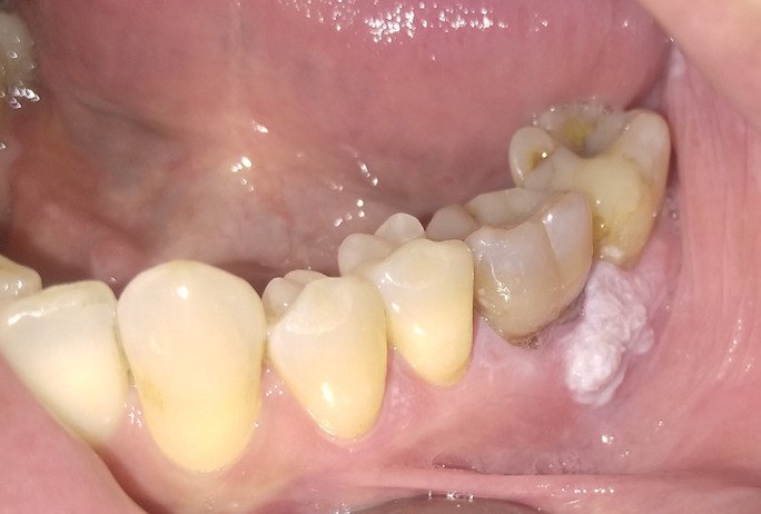 Papiloma por VPH blanquecino en la encía, junto a un molar inferior
