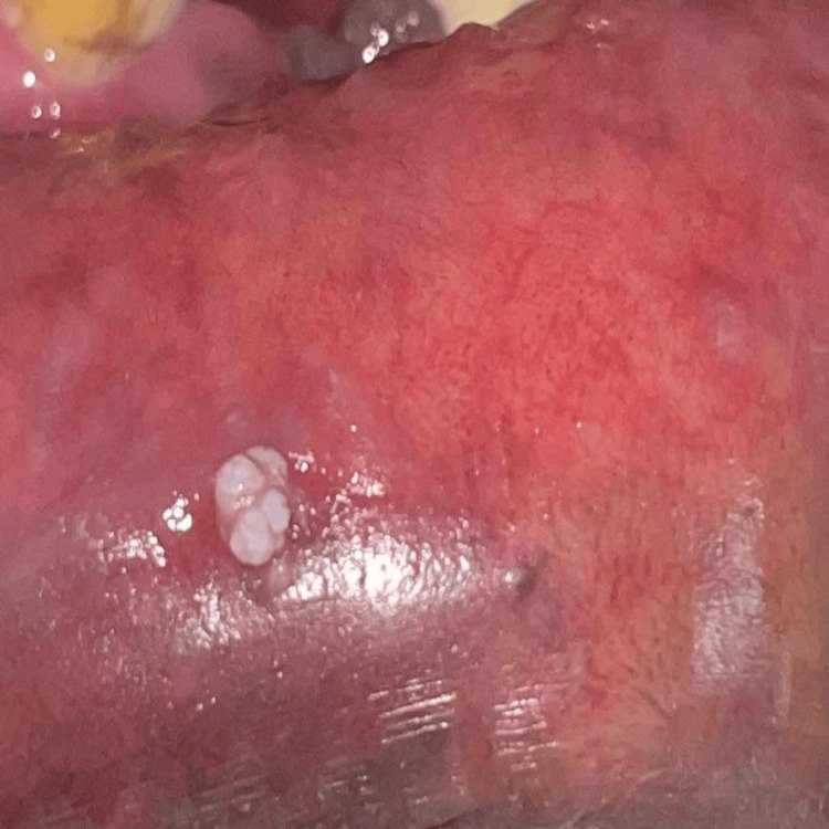 Papiloma por VPH blanco, con superficie de coliflor, en la cara interna del labio inferior
