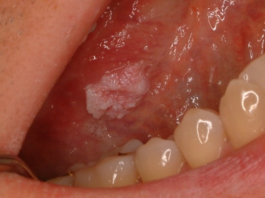 Papiloma por VPH pequeño y blanquecino, con superficie de coliflor, en el borde lateral de la lengua