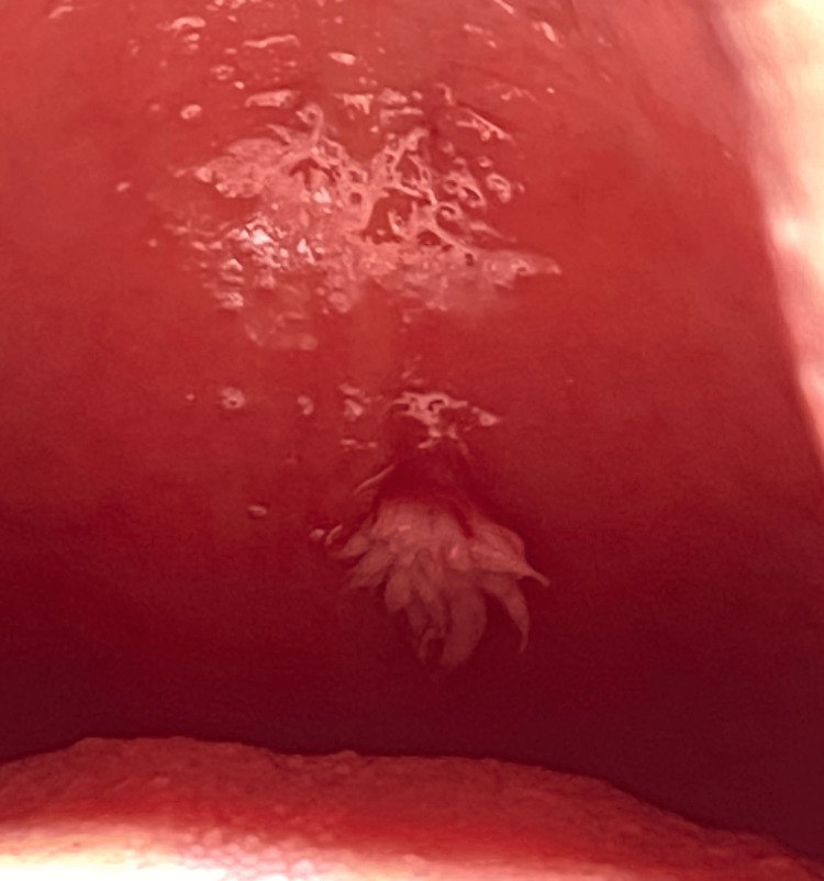 Papiloma por VPH con proyecciones blanquecinas en el paladar blando