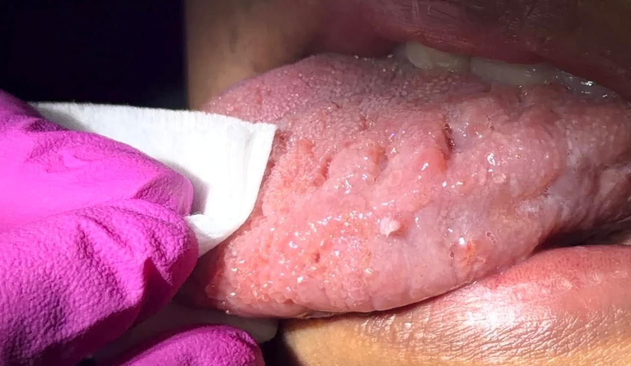 Lesiones de superficie rugosa en el borde lateral de la lengua, durante una exploración clínica